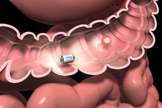 Bağırsak Kanserini Tespit Eden Röntgen Kapsülleri Bağırsak Kanserini Tespit Eden Röntgen Kapsülleri